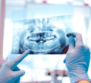 Dentist with blue gloves reviewing X-ray