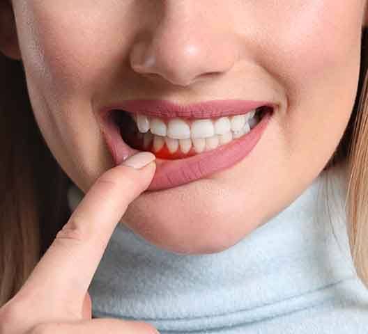 A woman showing her infected gum tissue