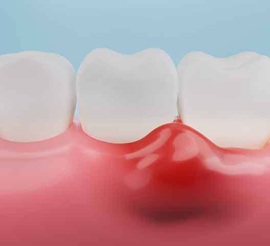 A 3D illustration of infected and inflamed gum tissue