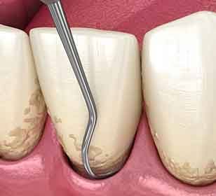 A 3D illustration of a scaling and root planing treatment