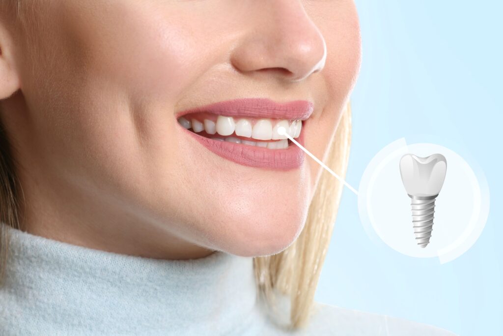 Nose to neck view of woman smiling with one tooth indicated as an implant